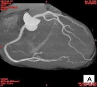 心臓冠動脈ＭＩＰ画像
