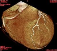 心臓３Ｄ・ＶＲ画像