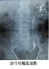 逆行性腎盂造影