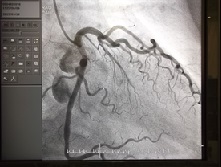 左冠動脈画像