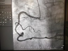 右冠動脈画像