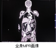 心臓冠動脈ＭＩＰ画像