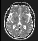 頭部T2画像
