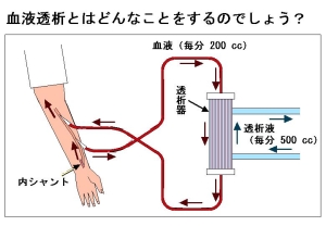 血液透析